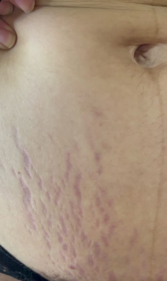 Depois do tratamento de estrias